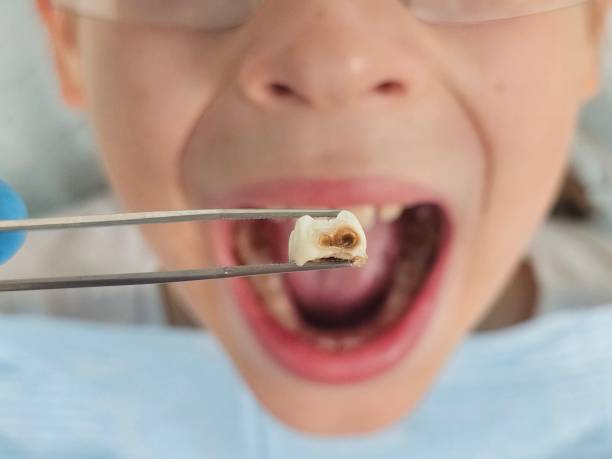Best Broken or Chipped Tooth Repair in Corydon, IN